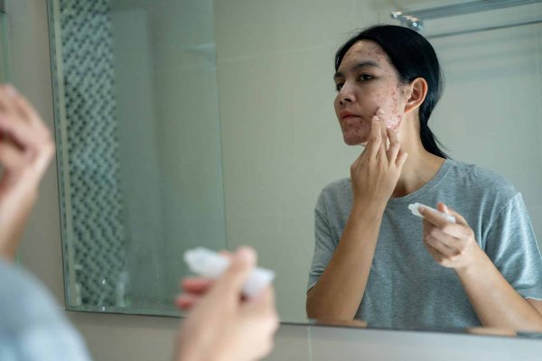 Comment utiliser l'huile essentielle d'arbre à thé pour combattre l'acné du dos?